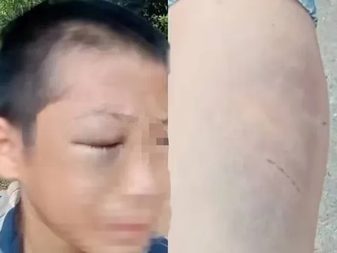 Bé trai nghi bị mẹ kế bạo hành nhiều lần: Người bố lên tiếng xin lỗi gia đình vợ cũ