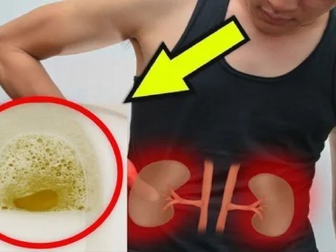Đi tiểu thấy nhiều bọt có phải bị suy thận?