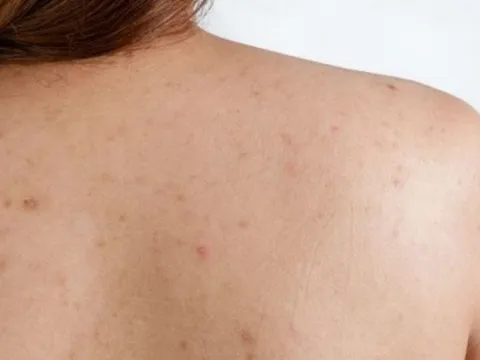 Mụn lưng bùng phát vào mùa hè: Những cách chăm sóc giúp da cơ thể thông thoáng hơn