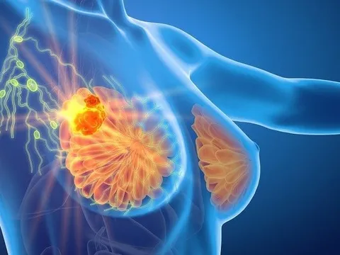“Thủ phạm” gây K tuyến vú nhiều nhất ở phụ nữ