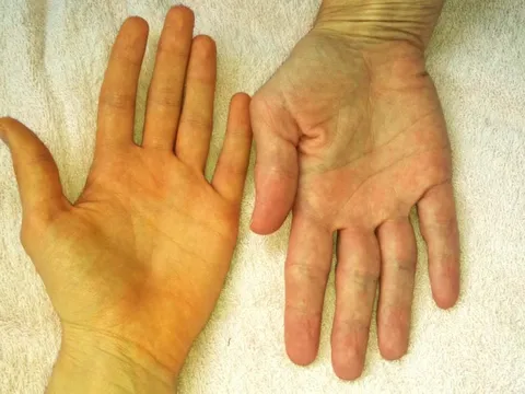 6 dấu hiệu trên cơ thể cảnh báo gan của bạn đang kêu cứu: Nên đi khám gấp