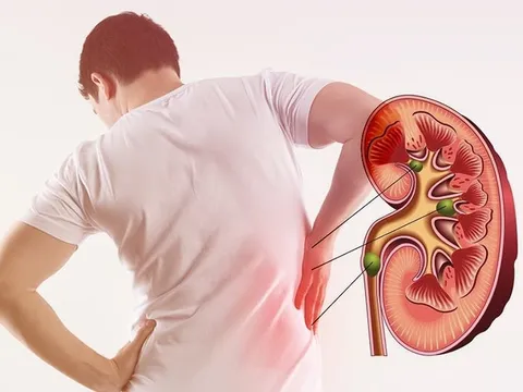 4 dấu hiệu cảnh báo thận của bạn đang kêu cứu