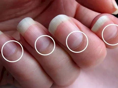 5 dấu hiệu trên móng tay chứng tỏ bạn đang mắc bệnh nan y