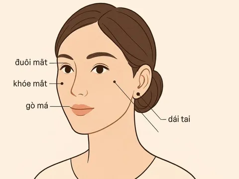 3 nốt ruồi trên mặt mang tới may mắn cho bạn: Cả đời bình an