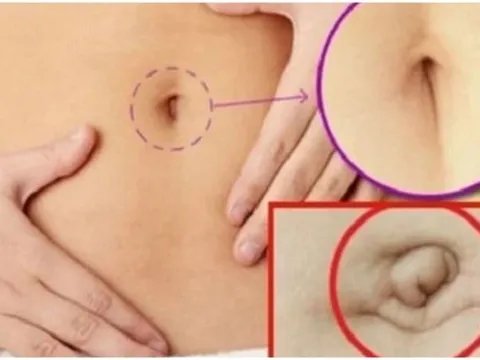 Nhìn tướng rốn 3 giây biết tương lai bạn giàu sang hay nghèo khổ