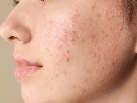 5 cách giúp giảm mụn cám tại nhà, hỗ trợ da thông thoáng và mịn màng hơn