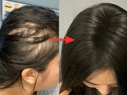 Lời khuyên dành phụ nữ có tóc rụng nhiều, mọc chậm, tóc càng ngày càng mỏng