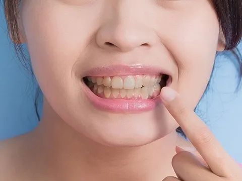 Vì sao răng dễ xỉn màu dù chăm đánh răng? Những nguyên nhân nhiều người thường bỏ qua