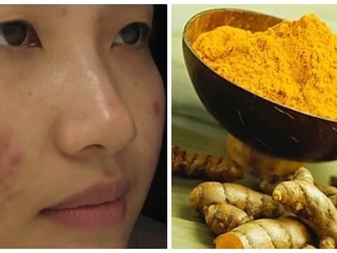 Cách trị sẹo tại nhà đơn giản, giúp da mịn màng hơn mỗi ngày