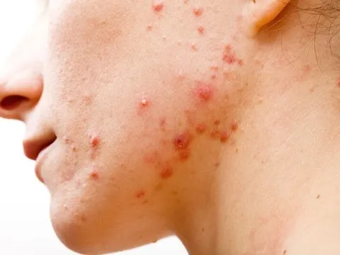 4 cách chăm sóc da khi bị mụn nhọt để hạn chế thâm sẹo và giúp da hồi phục nhanh hơn