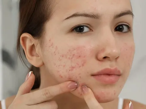 Cách làm mờ thâm mụn bằng kem đánh răng tại nhà