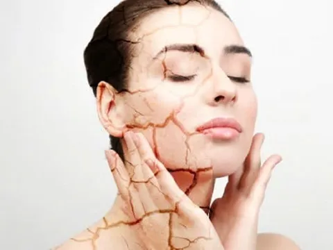 Nắng nóng đỉnh điểm khiến da dễ cháy nắng: Cách bảo vệ và phục hồi da đúng cách