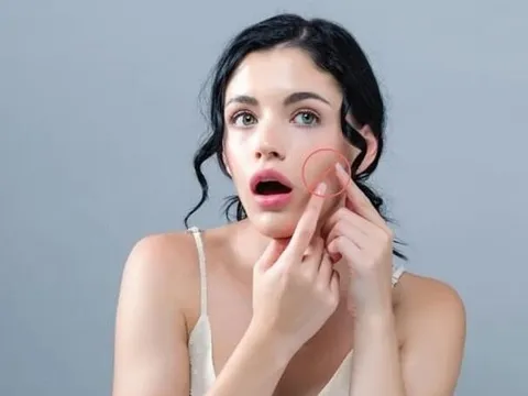 Chăm sóc da đúng cách sau nặn mụn giúp giảm nguy cơ thâm sẹo và phục hồi da nhanh hơn