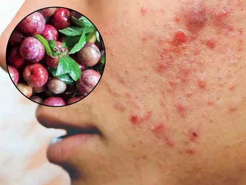 3 đối tượng không được ăn mận: Dễ nổi mụn, nóng trong