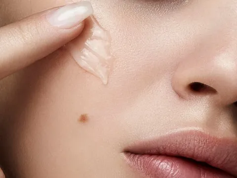 5 cách hỗ trợ làm mờ thâm lâu năm, giúp làn da đều màu và rạng rỡ hơn