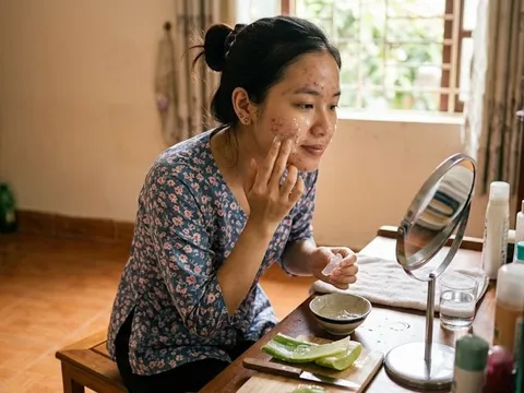 5 mẹo trị mụn ẩn bằng nha đam tại nhà: Da mịn màng chỉ sau 7 ngày