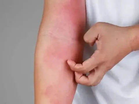 4 dấu hiệu cảnh báo bạn đang bị suy thận: Kiểm tra ngay xem bạn có không?