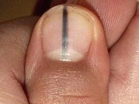 5 dấu hiệu trên móng tay cảnh báo bệnh nan y: Có 1 trong 5 dấu hiệu cũng nên đi khám gấp