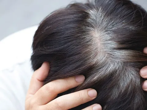 Tóc bạc sớm ở 3 vị trí này có thể là dấu hiệu gan, thận suy yếu