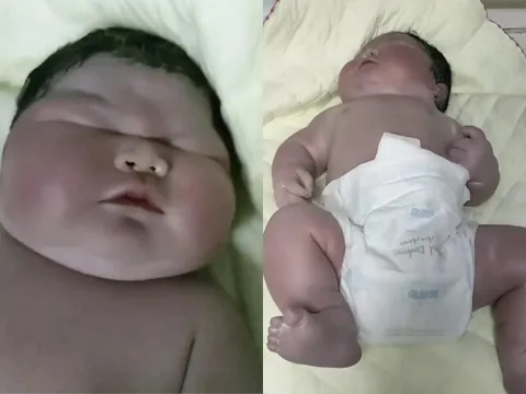 Chào đời nặng 13kg, da tím tái, bé sơ sinh khiến bác sĩ phải thốt lên: "Chưa từng thấy"