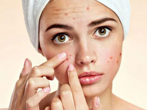 Học ngay bí quyết chăm sóc da mặt sau khi nặn mụn, giúp ngăn ngừa mụn tái phát